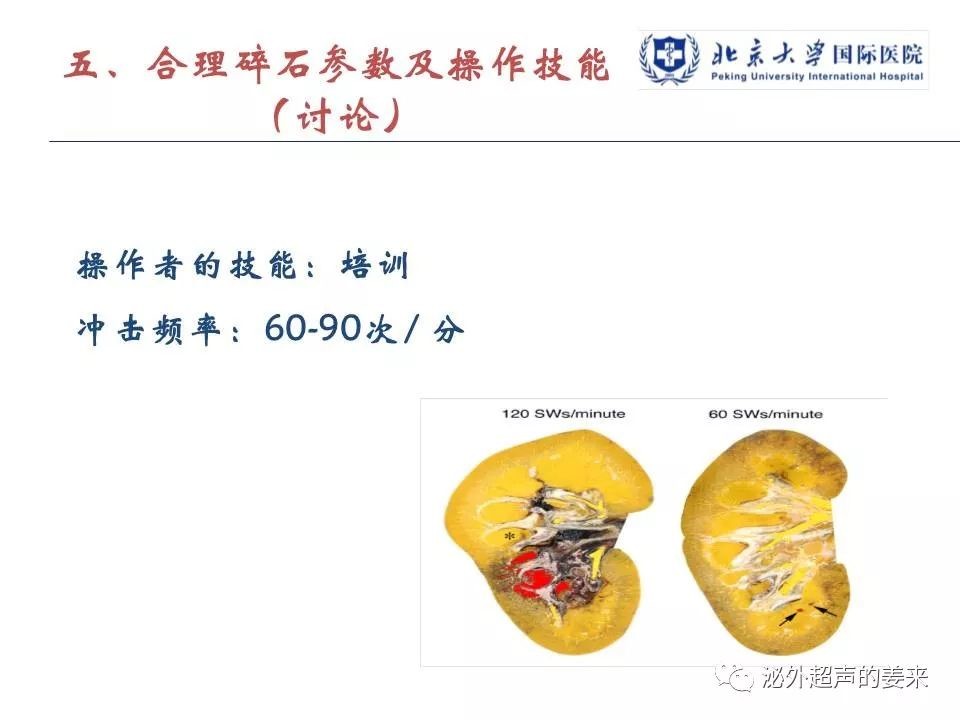 尿結石最新研究進展與治療方法